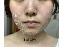 エステティック レイビス 池袋店(RAYVIS)/ハーブピーリング3日後夜