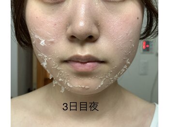 エステティック レイビス 池袋店(RAYVIS)/ハーブピーリング3日後夜