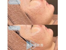 【ララピール】圧倒的 水光肌！ハリ！ツヤ！即効性あり！