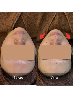 ビビ(VIVI)/ララピールで小顔に☆