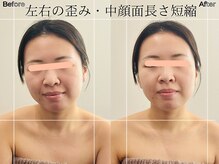 リストアハート(Restore Heart)/中顔面短縮・左右差の歪み解消