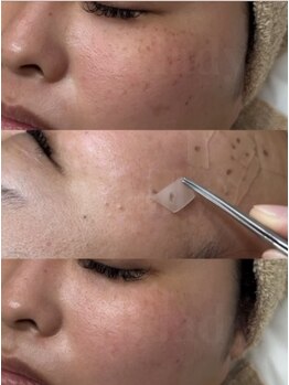 ホワイトスノー(W/S)の写真/医療提携ホワイトラボで叶える結果重視のシミケア