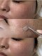 ホワイトスノー(W/S)の写真/医療提携ホワイトラボで叶える結果重視のシミケア