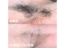 エピジュ(Epijyu)/男性のわき脱毛