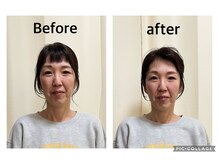 まごころ整骨院/美容鍼Before&After（1回施術）