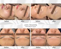アン ビューティー(ann beauty)
