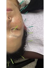 トウリンカ(tourinka)/美容鍼 むくみ/くすみなど