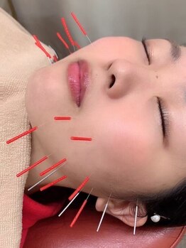 森脇鍼灸整骨院 吹田本院の写真/【美容鍼¥2980～】美容鍼で内部からアプローチ◎ほうれい線・たるみを改善し引き締まったフェイスラインへ!