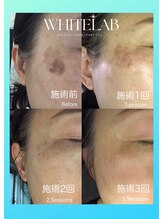 みや美/ホワイトラボ◆ビフォーアフター