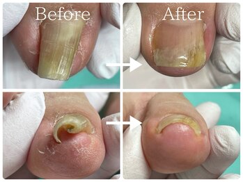 巻き爪補正店 金山店/巻き爪（初回と8回目）