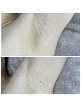 ブルーム(bloom)/ハーブピーリング/ララピール