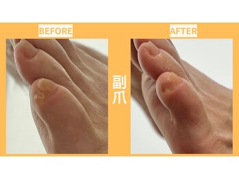 ウォーク イオンスタイル東淀川(WALK)/痛いウオノメ/副爪