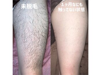 エピジュ(Epijyu)/男性の足脱毛(太もも)