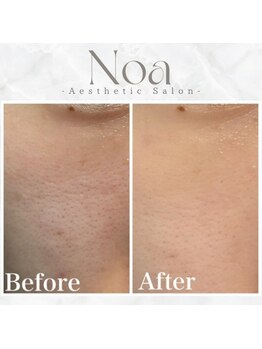 ノア 新宿(Noa)/ピーリング+ポレーション 1回
