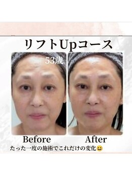 ミヤビ(MIYABI)/施術前後の変化