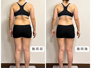 リンド(Lindo)/ハイパーナイフ×筋膜リリース