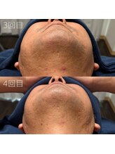 カナウ(KANAU)/ヒゲ脱毛（40代後半男性）