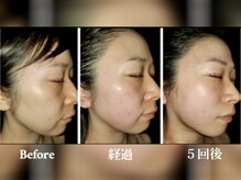 エフプラネット(F Planet)/小顔リフトアップ