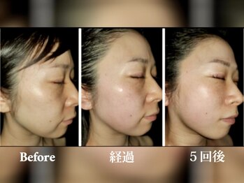 エフプラネット(F Planet)/小顔リフトアップ