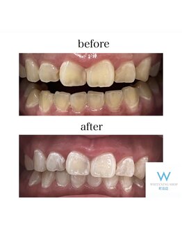 ホワイトニングショップ 町田店/【ビフォーアフター】5回