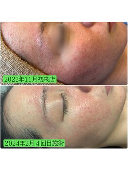 シューティングハーツ(SHOOTING HEARTS)/ハーブピーリング