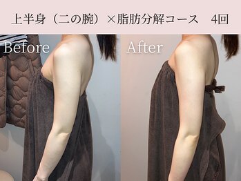 ミア(miiia)/上半身×脂肪分解コース 4回