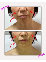 ユーフォリア(Euphoria)/ほうれい線と肌のトーンアップ