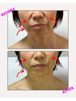 ユーフォリア(Euphoria)/ほうれい線と肌のトーンアップ