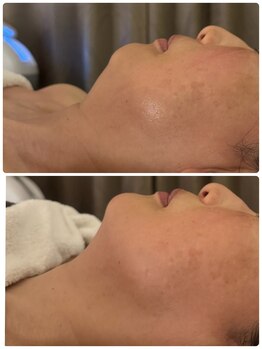 アンサー(ANSWER)/フェイスライン悩みも得意です