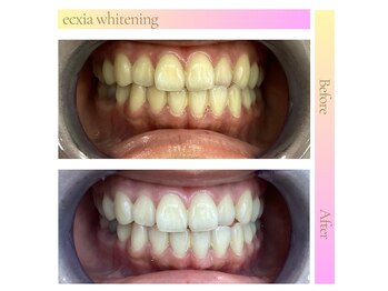 エクシア ホワイトニング 鶴岡店