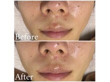 ルリミ(Relimi)の雰囲気（赤みなどの肌トラブル改善[ニキビケア/毛穴洗浄]）