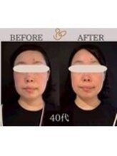 チョコバリ 錦糸町店(chocobari)/小顔×リフトアップ(美容鍼)40代