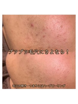 ブリリエット 天王寺店(Brilliet)/＊ハーブピーリング