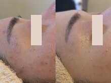 2ヶ月変化◎繰り返すニキビ、赤み。変化に繋げます。