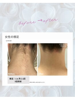 ノノ(nono)/うなじ～えりあし脱毛