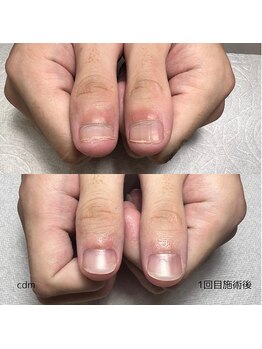 シーディーエム ジュエ(cdm jouer)/深爪でお悩みの方に