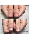 深爪でお悩みの方に
