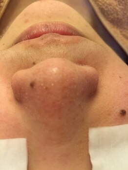 リアン(lien)/【フェイシャル】毛穴洗浄