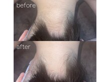 エピジュ(Epijyu)/女性のうなじ脱毛