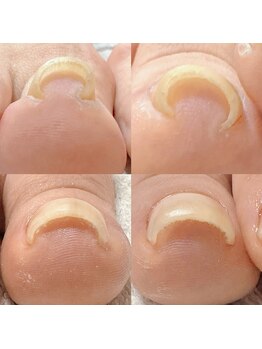 カンパニュラ(Campanula)/巻き爪ケア