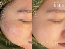 ベルプラス 新大阪(Belle plus)/ハーブピーリング｜韓国美肌