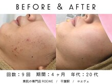 ロエヴェ(ROEWE)/ニキビ改善・毛穴ケア・肌質改善