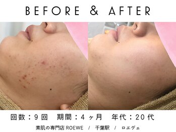 ロエヴェ(ROEWE)/ニキビ改善・毛穴ケア・肌質改善
