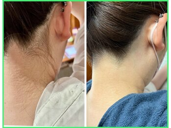 クリア 尾張旭店(Clear)/【Clear脱毛ビフォーアフター】