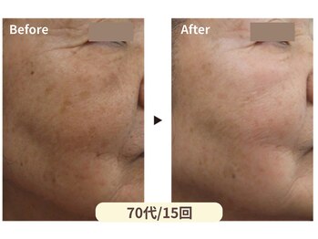 美男美女 奈良三条店/本気のシミ・シワ結果