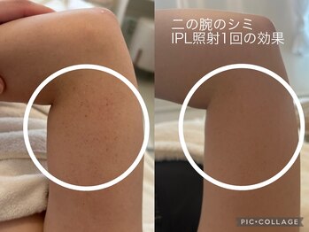 ナンバーナイン(No.9)/IPL腕のシミケア