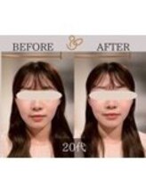 チョコバリ 錦糸町店(chocobari)/小顔×リフトアップ(美容鍼)20代