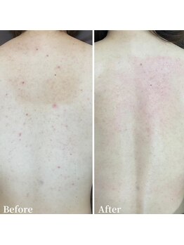 ニキビケア研究所 池袋店/赤みや背中ニキビでお悩みの方へ