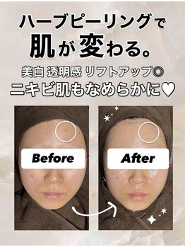 ビレボ マエバシ(BEREVO maebashi)/Before After