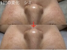トモニ(TOMONI)/40代　シミ×くすみ改善